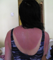 https://en.wikipedia.org/wiki/File:Sunburn2.jpg